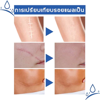 เจลซ่อมแซมรอยแผลเป็น เจลรอยแผลเป็น ครีมทาแผลเป็น ครีม สําหรับรอย ผ่าตัด น้ําร้อนลวก