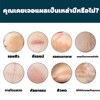 เจลซ่อมแซมรอยแผลเป็น เจลรอยแผลเป็น ครีมทาแผลเป็น ครีม สําหรับรอย ผ่าตัด น้ําร้อนลวก