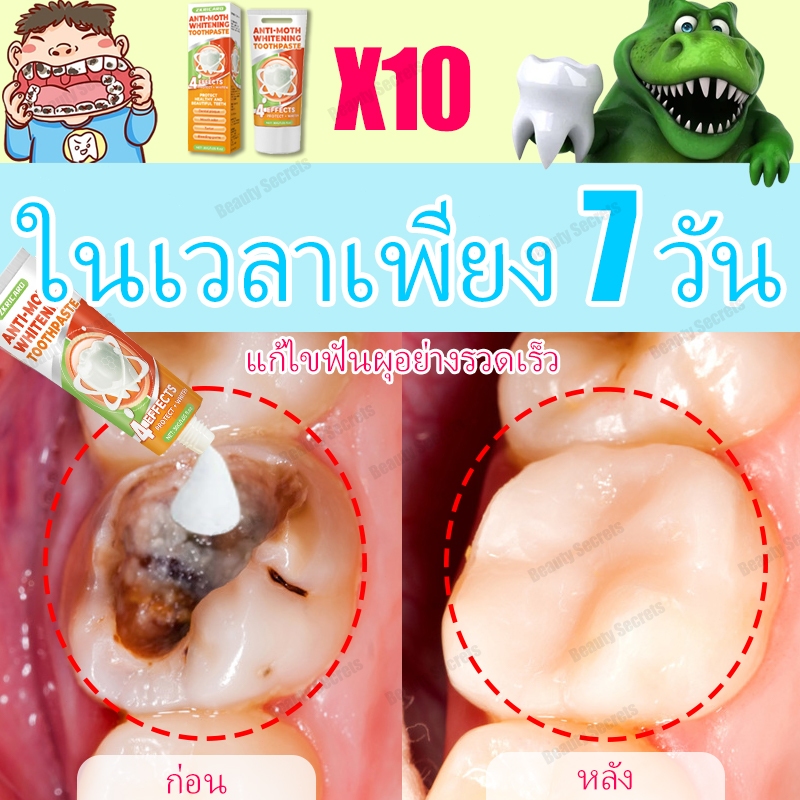 【ส่งเร็วทันใจ 】ยาสีสําหรับฟันผุ ซ่อมแซมฟันผุได้อย่างรวดเร็วและปกป้องสุขภาพ ยาสีป้องกันฟันผุ