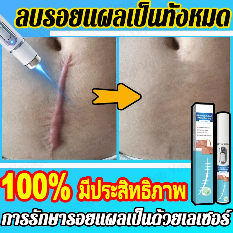 เลเซอร์พอยเตอร์กำจัดรอยแผลเป็น, ลดรอยแผลเป็น, การกําจัดรอยแผลเป็นจากสิว, ลดรอยแตกลาย, ลดรอยแผลเป็นเลเซอร์, รักษารอยแผลเป็น, การกําจัดแผลเป็นผ่าตัด