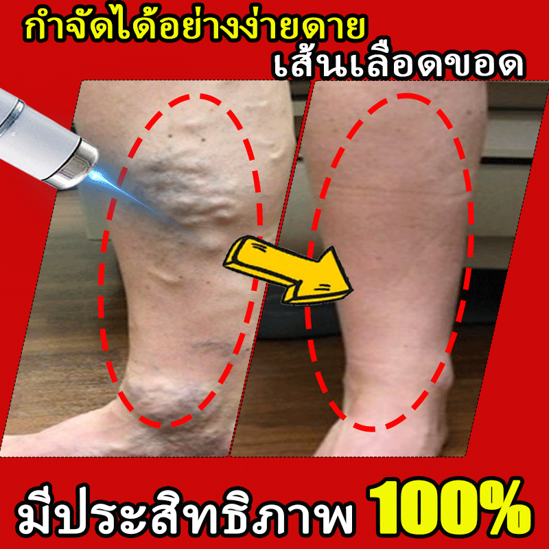 ขุดลอกเส้นเลือดที่ถูกต้อง แก้เจ็บคอ บวมและปวด ส่งเสริมการหักใหม่ในการไหลเวียนโลหิต และอย่างปลอดภัยและปรับปรุงปัญหาหลอดเลือดที่มีประสิทธิ