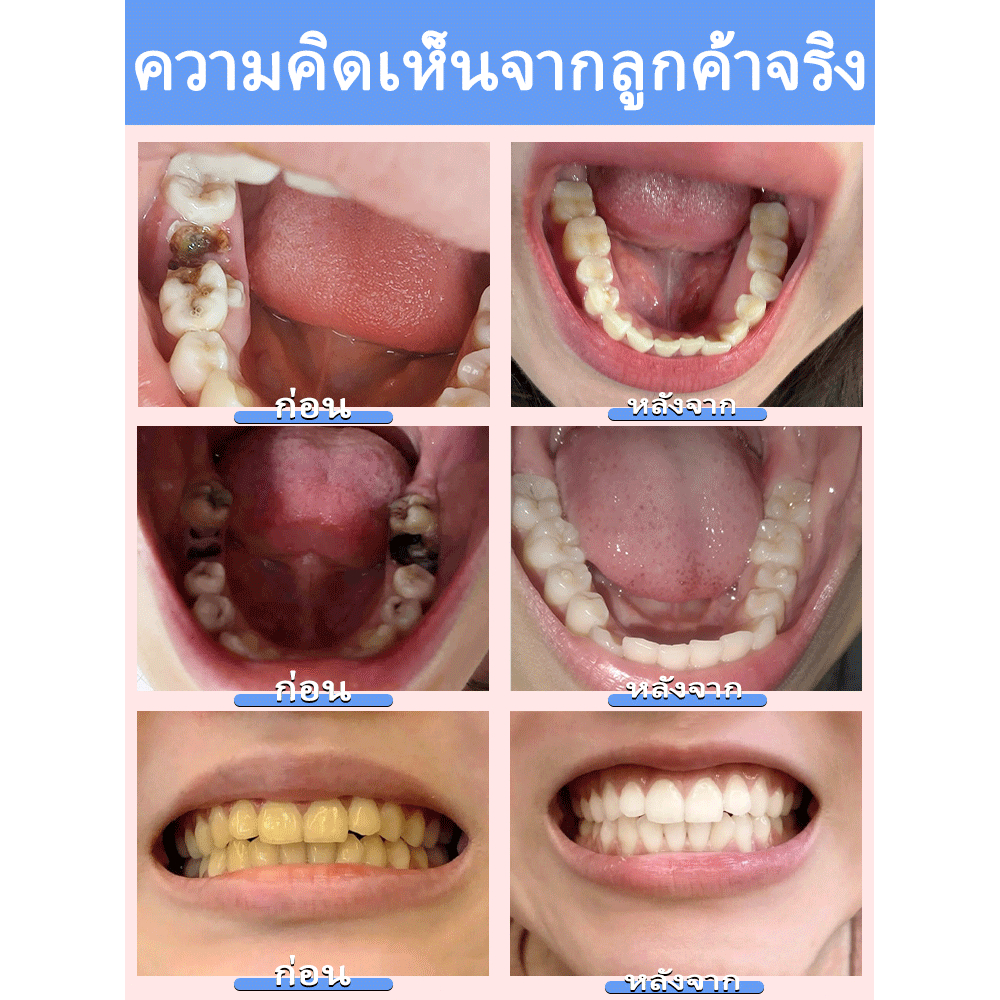 ยาสีฟันฟื้นฟูฟลูออไรด์, ป้องกันฟันผุ, อุดเคลือบฟัน, ฟันไม่แพ้ง่ายยาสีฟันป้องกันฟันผุปราศจากฟลูออไรด์ซ่อมแซมโพรงอย่างรวดเร็วและป้องกันสุขภาพ - รูปที่ 2