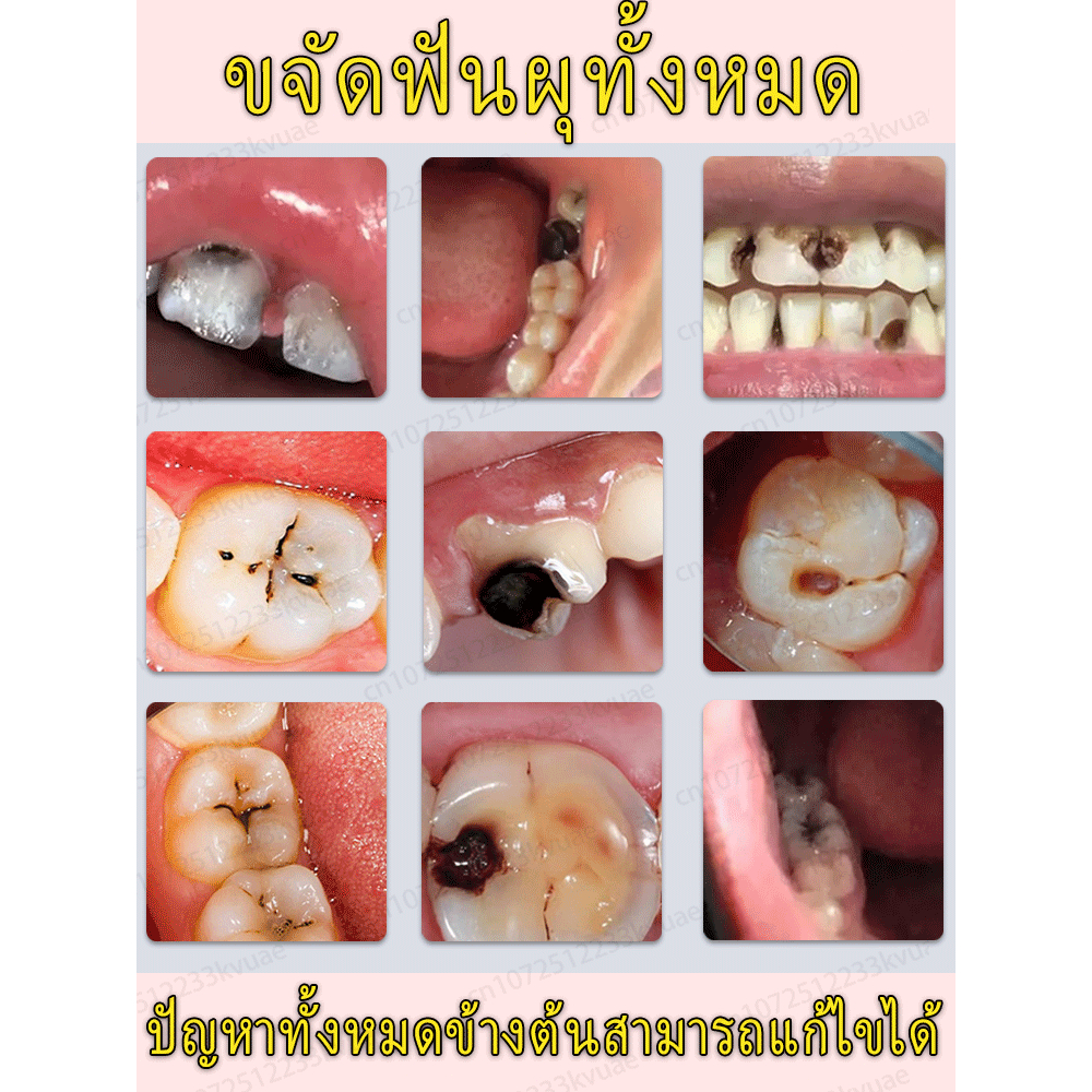 ยาสีฟันไวท์เทนนิ่งและป้องกันฟันผุรักษาฟันผุ เหงือกร่น ป้องกันฟันผุ ฟันขาว ป้องกันเหงือกอักเสบ ยาสีฟันขจัดคราบ ลมหายใจสดชื่น ราคา ถูกที่สุด ดีลบีเคเค แกลเลอรีภาพที่ 3