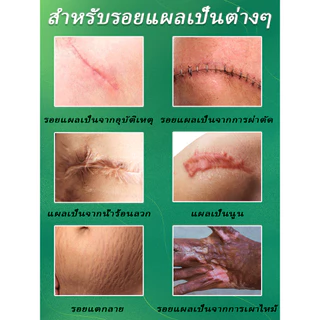 พิสูจน์แล้วว่ารักษารอยแผลเป็นใน 7 วัน ขจัดรอยแผลเป็นทุกประเภท หยุดรอยแผลเป็นจากการผ่าตัด ออกแบบมาเพื่อขจัด บอกลาจากสิว จางลงอย่างรวดเร็ว