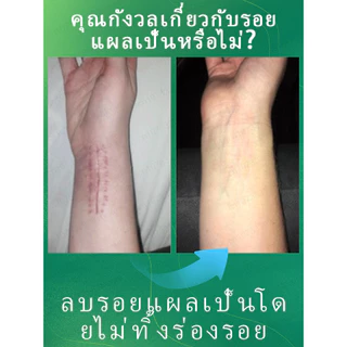 พิสูจน์แล้วว่ารักษารอยแผลเป็นใน 7 วัน ขจัดรอยแผลเป็นทุกประเภท หยุดรอยแผลเป็นจากการผ่าตัด ออกแบบมาเพื่อขจัด บอกลาจากสิว จางลงอย่างรวดเร็ว