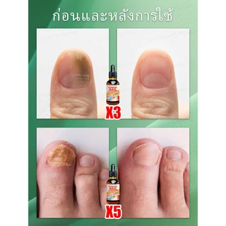 [น้ํามันหอมระเหยทําเล็บนําเข้าจากเยอรมัน] ป้องกันเชื้อรา + เล็บหนานุ่มนวล + ซ่อมแซมสีเหลืองและเคลือบ + ป้องกันการหมุนเวียน | สามขั้นตอนเพื่อกระจ่างใสเล็บ