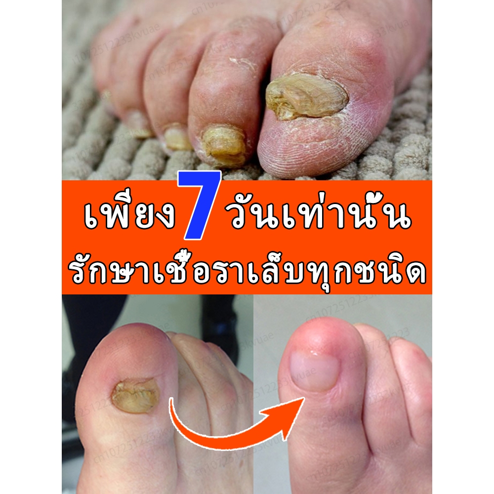 [น้ํามันหอมระเหยทําเล็บนําเข้าจากเยอรมัน] ป้องกันเชื้อรา + เล็บหนานุ่มนวล + ซ่อมแซมสีเหลืองและเคลือบ + ป้องกันการหมุนเวียน | สามขั้นตอนเพื่อกระจ่างใสเล็บ
