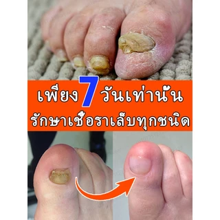 [น้ํามันหอมระเหยทําเล็บนําเข้าจากเยอรมัน] ป้องกันเชื้อรา + เล็บหนานุ่มนวล + ซ่อมแซมสีเหลืองและเคลือบ + ป้องกันการหมุนเวียน | สามขั้นตอนเพื่อกระจ่างใสเล็บ