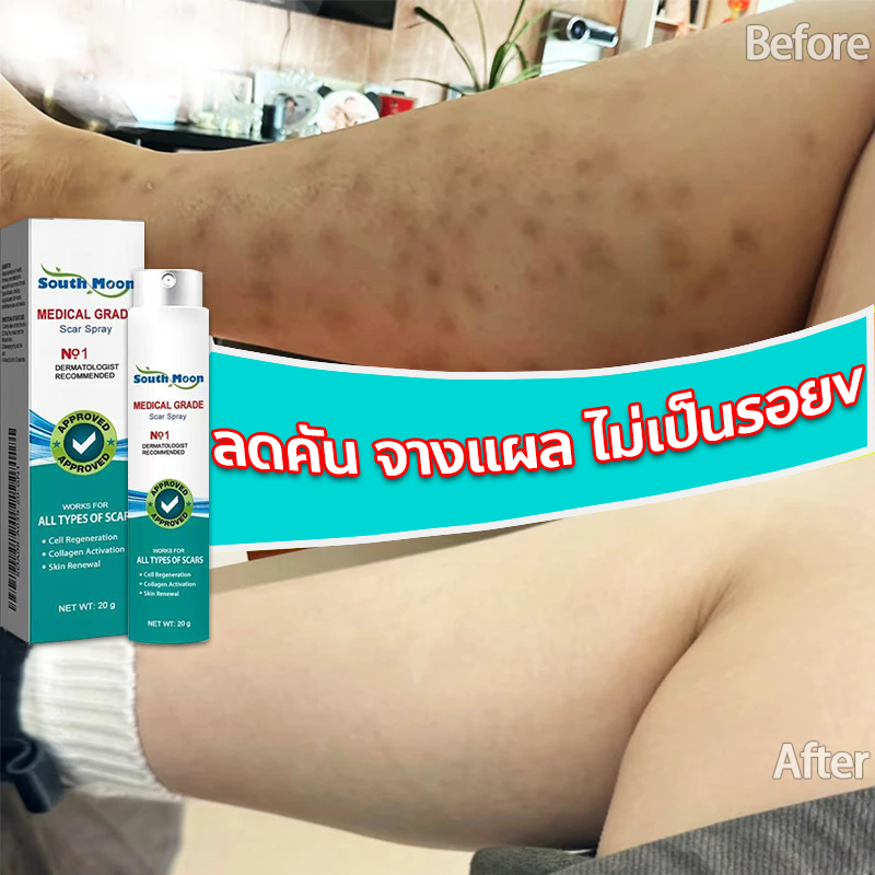 ✨ของแท้✨ South Moon สเปรย์ลบรอยแผลเป็น ลบรอยแผลเป็น ลดรอยแผลเป็น กำจัดรอยแผลเป็น รอยดำจากแผล รอยยุงก