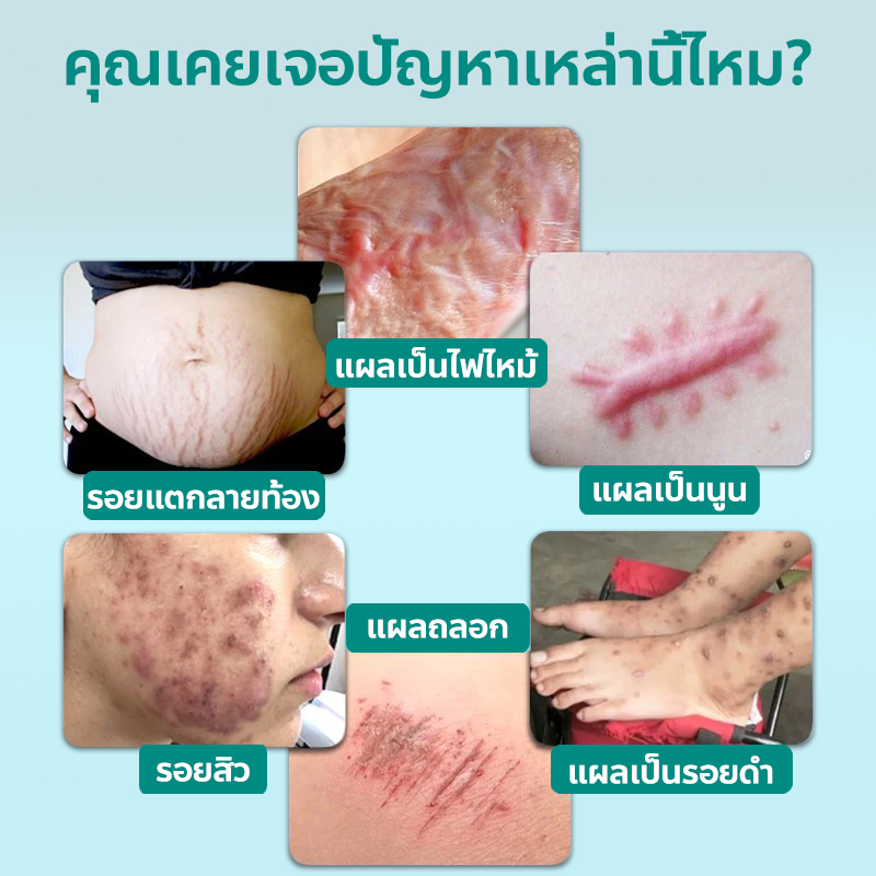 ✨ของแท้✨ South Moon สเปรย์ลบรอยแผลเป็น ลบรอยแผลเป็น ลดรอยแผลเป็น กำจัดรอยแผลเป็น รอยดำจากแผล รอยยุงกัด รอยแผลจากการผ่าตัด รอยแตกลาย รอยสิว ไม่มีการระคายเคืองผิว ลดรอยแผลเป็น ฟื้นฟูผิว คืนความเรียบเนียนให้ผิว 20g ราคา ถูกที่สุด ดีลบีเคเค แกลเลอรีภาพที่ 2