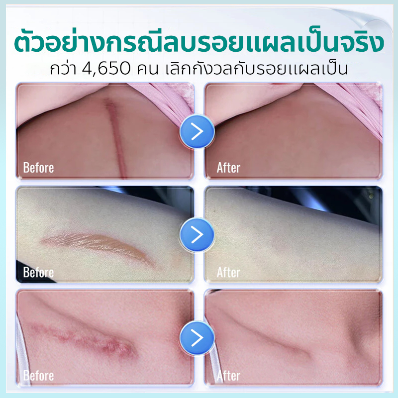 ✨ของแท้✨ South Moon สเปรย์ลบรอยแผลเป็น ลบรอยแผลเป็น ลดรอยแผลเป็น กำจัดรอยแผลเป็น รอยดำจากแผล รอยยุงกัด รอยแผลจากการผ่าตัด รอยแตกลาย รอยสิว ไม่มีการระคายเคืองผิว ลดรอยแผลเป็น ฟื้นฟูผิว คืนความเรียบเนียนให้ผิว 20g ราคา ถูกที่สุด ดีลบีเคเค แกลเลอรีภาพที่ 3