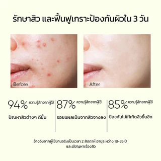 【5PCS】SADOER 3% Salicylic Acid Acne Set ลดสิว รักษาสิว รอยสิว With Gift
