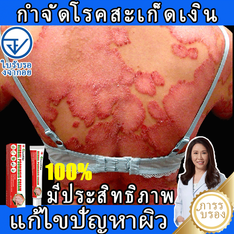 บรรเทาอาการคัน ครีมต้านเชื้อรา ครีมแก้คัน ครีมสะเก็ดเงิน ต่อสู้กับการติดเชื้อรา โรคกลาก ครีมบำรุงผิว