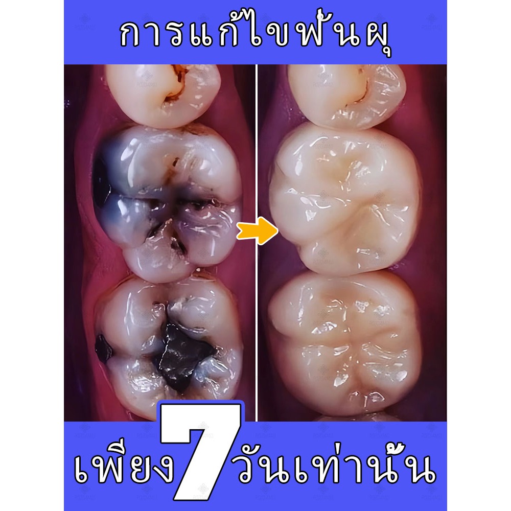 ยาสีฟันป้องกันฟันผุ ฟื้นฟูเคลือบฟัน เสริมสร้างความแข็งแรง ซ่อมแซม ป้องกันฟันผุ ฟอกฟันขาว ยาสีฟันฟลูออไรด์