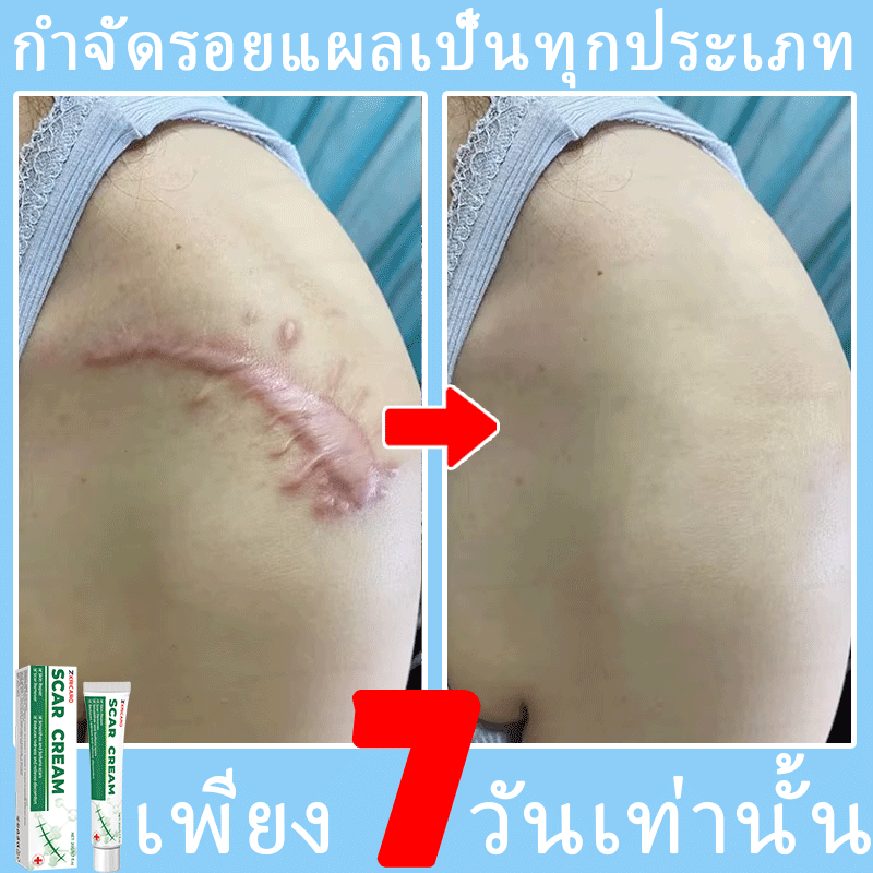 ลดเลือนรอยแผลเป็นและฟื้นฟูผิวให้เรียบเนียน ช่วยลดเลือนรอยแผลเป็นจากการผ่าตัด รอยสิว รอยไหม้ และรอยแตกลายหลังคลอด เป็นผลิตภัณฑ์ลดเลือนริ้วรอยมหัศจรรย์ที่สามารถใช้ได้อย่างปลอดภัยระหว่างให้นมบุตร