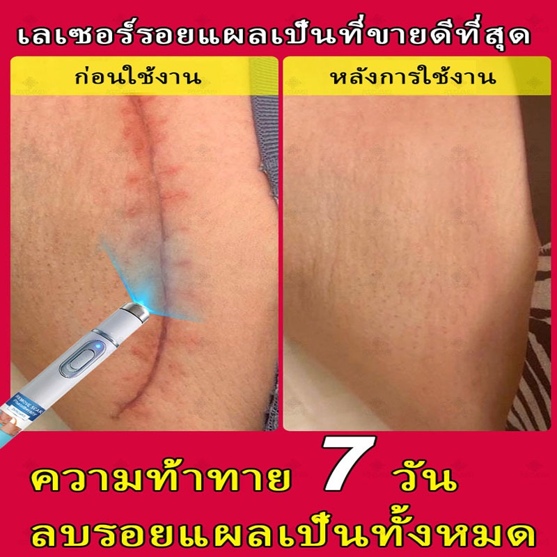 ลบรอยแผลเป็น รอยไหม้ รอยลวก รอยแตกลาย กําจัดรอยแผลเป็นทุกชนิด ผลิตภัณฑ์เลเซอร์ลบรอยแผลเป็น