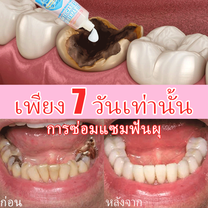 ยาสีฟันไวท์เทนนิ่งและป้องกันฟันผุรักษาฟันผุ เหงือกร่น ป้องกันฟันผุ ฟันขาว ป้องกันเหงือกอักเสบ ยาสีฟันขจัดคราบ ลมหายใจสดชื่น ราคา ถูกที่สุด ดีลบีเคเค