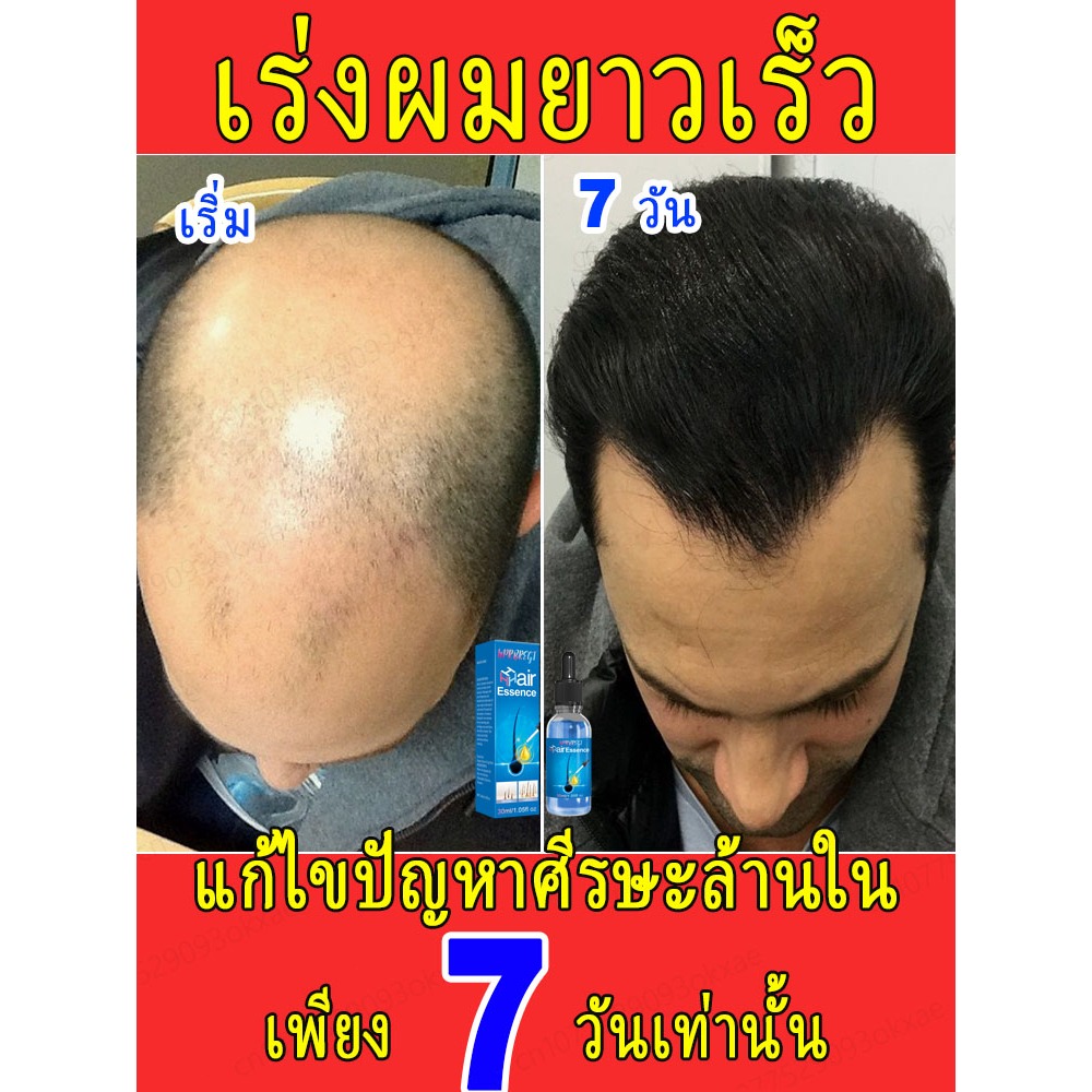 ✈️เอสเซนส์เร่งผมยาว นำเข้าจากอเมริกา✈️ ป้องกันผมร่วงได้แน่นอนส่งเสริมการเจริญเติบโตของเส้นผมอย่างรวดเร็ว ช่วยให้ผมยาวหนาขึ้นและเงางามมากขึ้น
