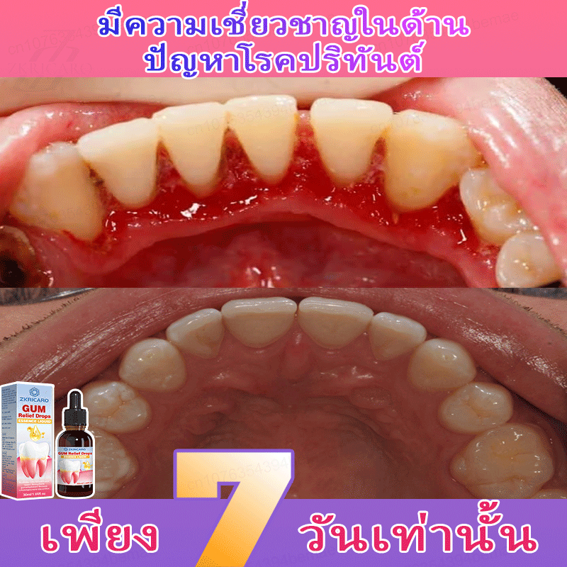 ลมหายใจสดชื่น โรคเหงือกอักเสบ เหงือกร่น บรรเทาเหงือกบวมและปวด ซ่อมแซมเหงือกร่น ซ่อมแซมเหงือกที่เลือดออก ทำความสะอาดอย่างล้ำลึก
