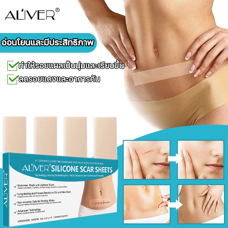 🍀ของแท้🍀 ALIVER แผ่นแปะรักษาแผลเป็น แผ่นซิลิโคนลบรอยแผลเป็น รักษาแผลเป็นทุกชนิด ทั้งแผลเป็นนูน แผลเป็นจากการผ่าตัด แผลเป็นที่คอจากไทรอยด์ แผลเป็นจากไฟไหม้ น้ำร้อนลวก