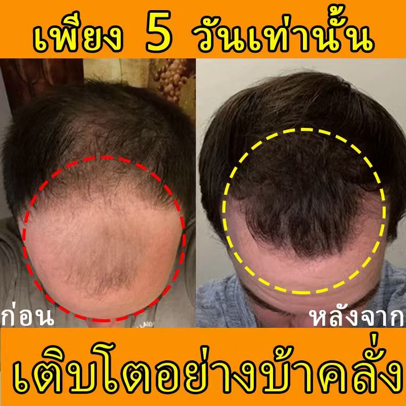【เร่งผมยาวภายใน 7 วัน】เอสเซนส์เร่งผมยาว เอสเซนส์ดูแลเส้นผม เอสเซนส์ป้องกันผมร่วง บำรุงหนังศีรษะ กระตุ้นการเจริญเติบโตของเส้นผมอย่างรวดเร็ว ทำให้ผมหนา