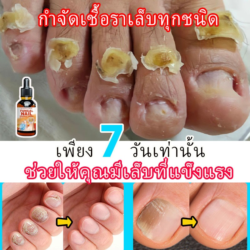 【ซ่อมแซมเชื้อราที่เล็บ】การรักษาเชื้อราที่เล็บ การรักษาเล็บด้วยยาต้านแบคทีเรีย การป้องกันการติดเชื้อราที่จำเป็น กำจัดเชื้อราที่เล็บ เล็บมือ เล็บเท้า เซรั่มซ่อมแซมเล็บ