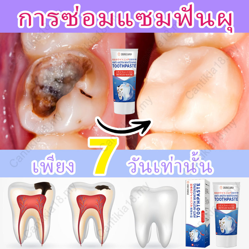 【ขายดีที่สุด】ยาสีฟันสำหรับซ่อมแซมฟันผุ ป้องกันฟันผุ ปกป้องฟัน บรรเทาอาการปวด ยาสีฟันลดอาการเสียวฟัน