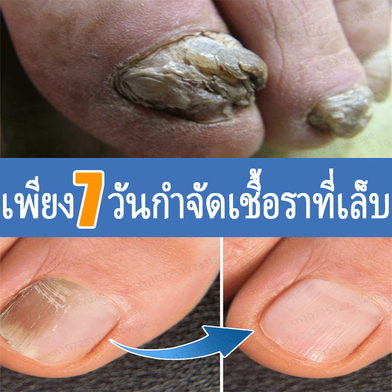 ลบเชื้อราที่เล็บ, บํารุง, สเปรย์, รักษาเชื้อรา, การดูแลเล็บ, ส่งเสริมการซ่อมแซมเล็บ, สเปรย์เชื้อรา,