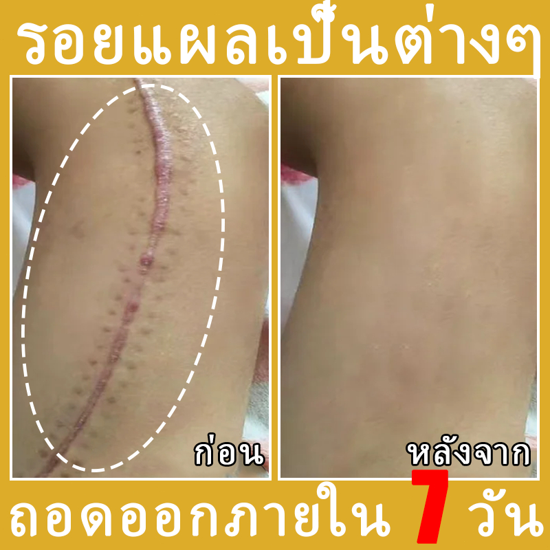 เจลลบรอยแผลเป็นสิว เจลลบรอยแผลเป็น ครีมลบรอยแผลเป็น เจลลบรอยแผลเป็น รอยแผลเป็น ครีมลบรอยแผลเป็น รอยแผลเป็นนูน หาย