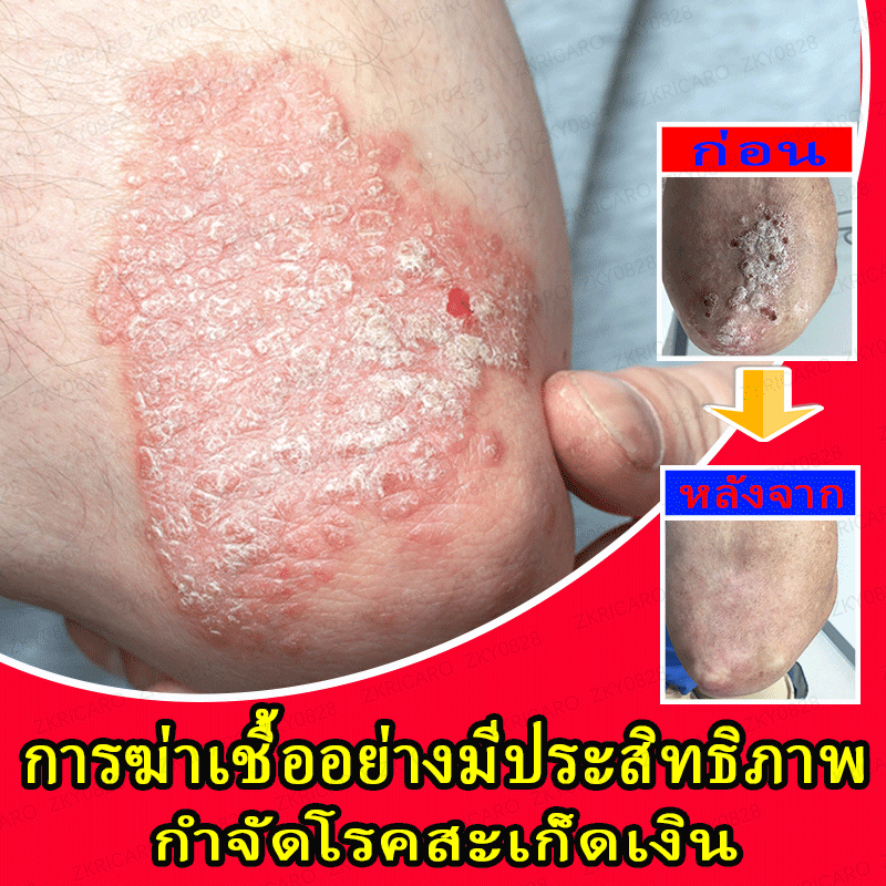 โรคสะเก็ดเงิน, โรคผิวหนัง, ครีมรักษาโรคงูสวัด, ครีมรักษาโรคสะเก็ดเงิน, รอยแดง, โรคผิวหนัง, โรคกลาก, โรคผิวหนังอักเสบ, อาการคัน, สมุนไพร, อาการคันเรื้อรัง, อาการคันบริเวณขาหนีบ.