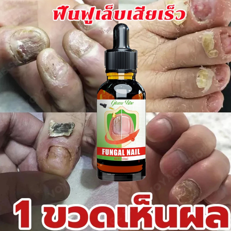 🚀มีผลภายใน 7 วัน🚀เซรั่มซ่อมแซมเล็บ น้ํายารักษา โรคเชื้อราที่ โรคเชื้อราที่ โรคเชื้อราที่เล็บ รักษาเล็บคุด เล็บหัก กําจัดเชื้อรา ดูแลเล็บ