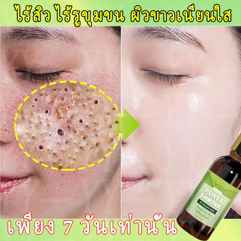 มีประสิทธิภาพใน 7 วันเอสเซ้นส์บํารุงผิวหน้าควบคุมความมันและให้ความชุ่มชื้นรูขุมขนหดตัวรอยสิวจางลงกําจัดสิวหัวดําทําความสะอาดใบหน้าลดสิว สูท