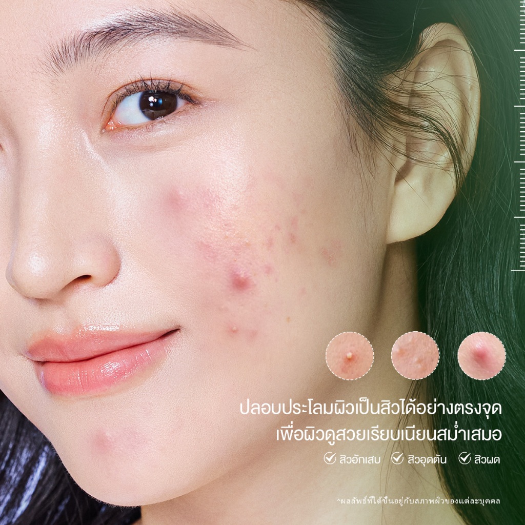 【NEW LUANCH】SKINTIFIC Acne Drying Lotion ช่วยทำให้สิวแห้งยุบเร็ว Salicylic Acid และ Betaine ลดโอกาสการเกิดสิวใหม่ - รูปที่ 2
