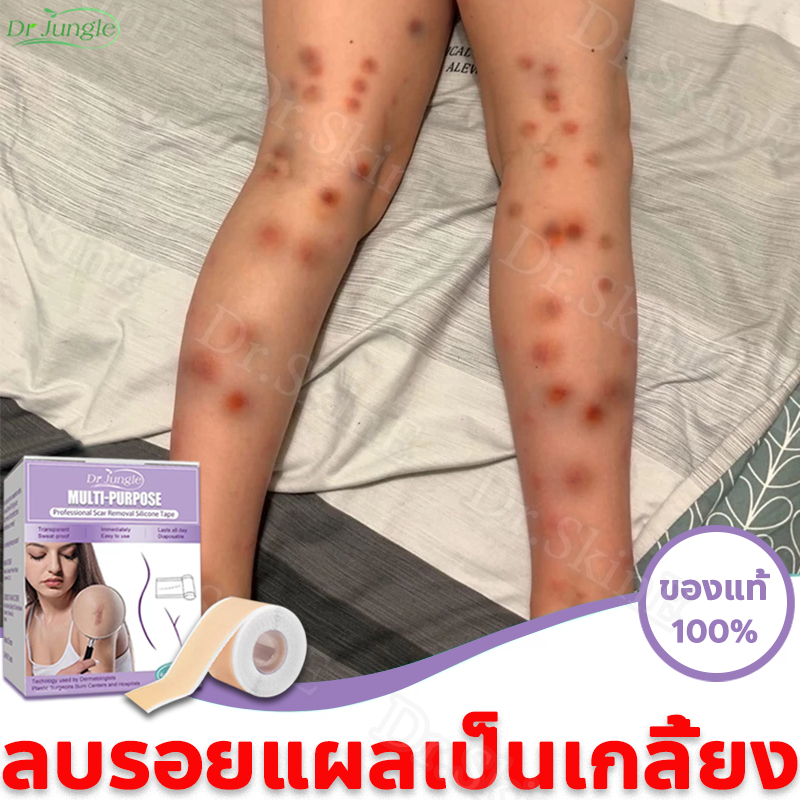 ⚡ ของแท้ ⚡DR JUNGLE แผ่นแผลเป็น แผ่นแปะลบแผลเป็น ครีมลบแผลเป็น แผ่นลบรอยแผลเป็น แผ่นลดรอยแผลเป็นนูน แผ่นซิลิโคนลบแผลเป็น กันน้ำกันเหงื่อ แผลผ่าคลอด แผลไฟไหม้ แผลน้ำร้อนลวก แผลถลอกจา