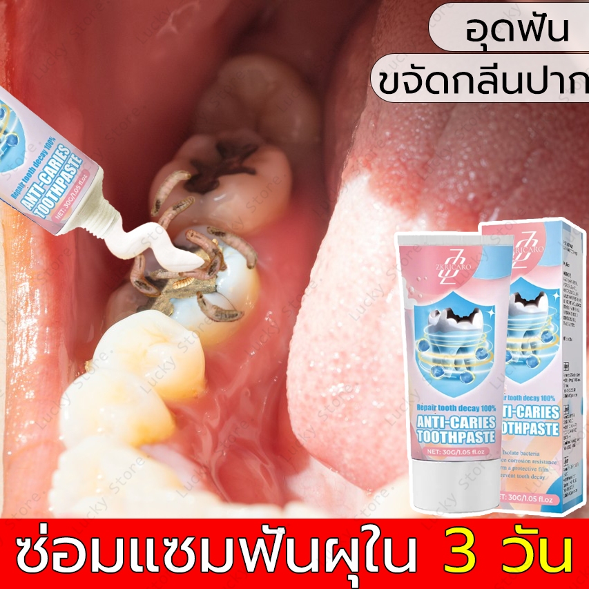 ยาสีฟันป้องกันฟันผุสามารถป้องกันฟันผุได้ด้วยการทำความสะอาดอย่างล้ำลึก ปกป้องฟัน ป้องกันฟันผุ และทำให้ลมหายใจสดชื่น ยาสีฟ