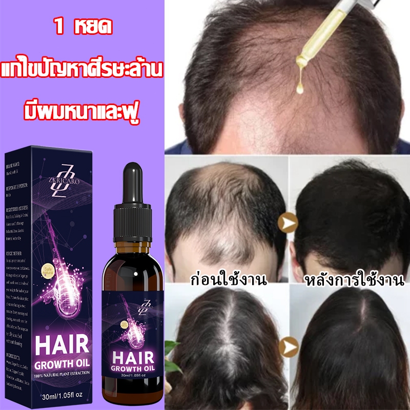 เซรั่มปลูกผมแท้ เร่งผมเกิดใหม่ บอกลาหัวล้าน ป้องกันผมร่วง ลดผมร่วง บํารุงลึกถึงรากผม