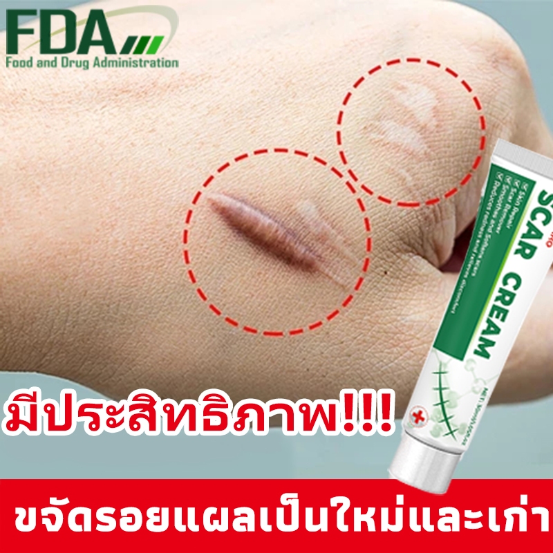 ⚡บอกลารอยแผลเป็น⚡ครีมทาแผลเป็น เจลแผลเป็น ครีมลดรอยแผลเป็น ลดรอยแผลเป็น รอยแผลเป็น ลบรอยสิว ลดแผลเป็นนูน เหมาะสําหรับแผลเป็นทุกชนิด