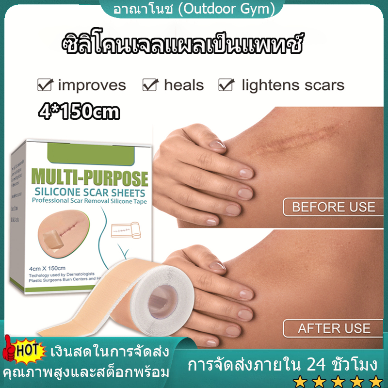 【จัดส่งท้องถิ่น】ซิลิโคนเจลแถบแพทช์ซิลิโคนแผลเป็นแผ่นนํามาใช้ใหม่ซิลิโคนแผลเป็นกําจัดแพทช์ลบ ทูมะ เผาแผลเป็นแผ่นซ่อมแซมผิวกําจัดรอยแผลเป็นแพทช์บําบัด