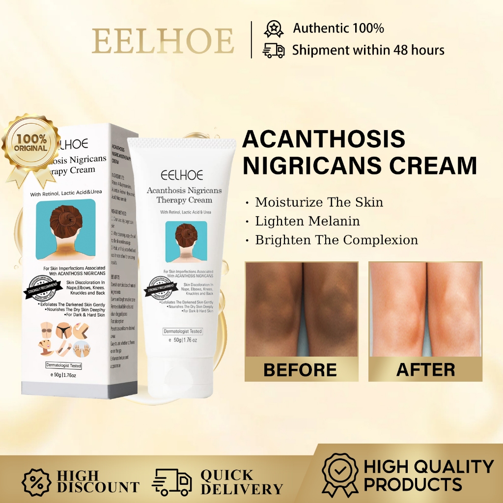 ปลาไหล Acanthosis Nigricans Therapy ครีม 50g รักแร้ Joint ครีมไวท์เทนนิ่ง เข่า Knuckle Whitening Removal Of รอยดํา