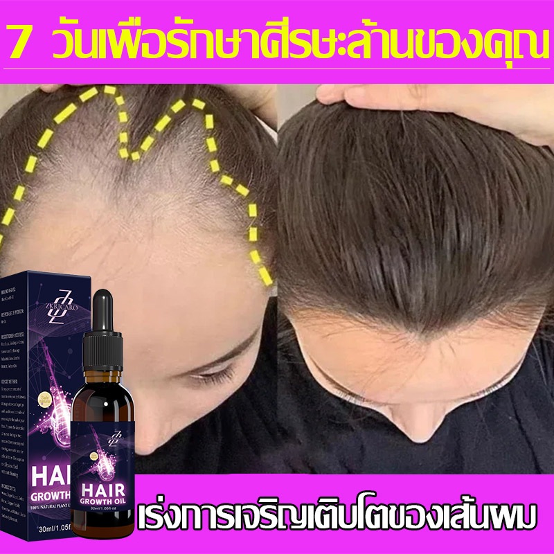 เอสเซ้นส์ปลูกผมอย่างรวดเร็วบอกลาหัวล้านเร่งการเจริญเติบโตของเส้นผมใหม่ซ่อมแซมผมบางน้ํามันหอมระเหยครีมปลูกผมป้องกันผมร่วงดูแลเส้นผมมืออาช