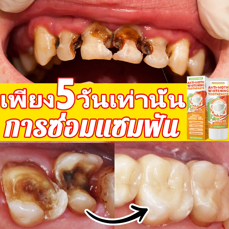 ยาสีฟันฟอกฟันขาวและป้องกันฟันผุ ซ่อมแซมฟันผุ ขจัดคราบฟันและเหงือกบวม ยาสีฟันผสมฟลูออไรด์ ขจัดคราบฟัน ฟันหลุด สะอาดล้ำลึก ลมหายใจหอมสดชื่น