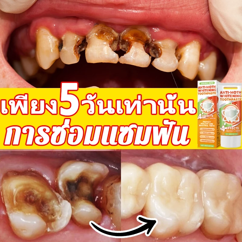 ยาสีฟันป้องกันฟันผุ ผสมฟลูออไรด์ ขจัดคราบ ลมหายใจหอมสดชื่น สูตรอ่อนโยนต่อเหงือก