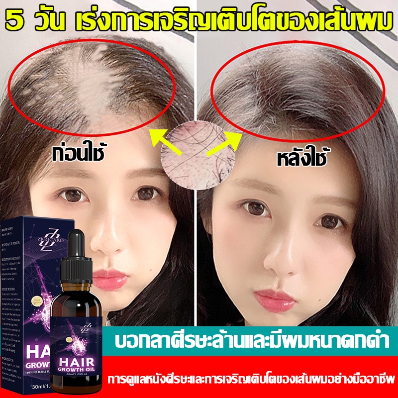 เร่งการเจริญเติบโตของเส้นผม 5 วัน กระตุ้นการงอกใหม่ บอกลาหัวล้าน บํารุงรากผมลึก สร้างผมหนาตามธรรมชาติ ใส่ได้ทั้งชายและหญิง
