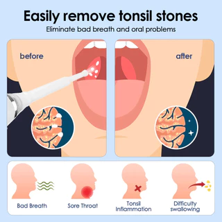 มองเห็นไฟฟ้า Tonsil Stone Remover เครื่องมือที่มองเห็นได้ Tonsil Stone Removal Kit 3 โหมดการดูด Tonsil Stone Removal Oral Care