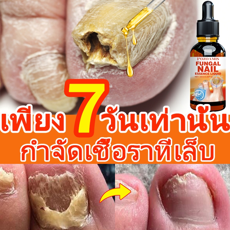 ✈️นำเข้าจากประเทศญี่ปุ่น✈️เซรั่มซ่อมแซมเล็บ เชื้อราที่เล็บ ลบ โรคเชื้อราที่เล็บคุด ซ่อมแซมเล็บ เซรั่มบํารุงเล็บ ลดเชื้อราที่เล็บ บรรเทาอาการคัน