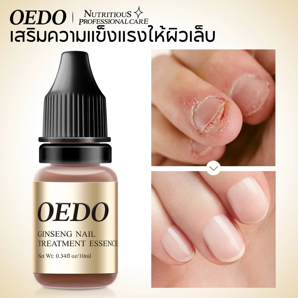 OEDO รักษาเชื้อราเล็บขบ ยาทาฆ่าเชื้อราที่เล็บ
