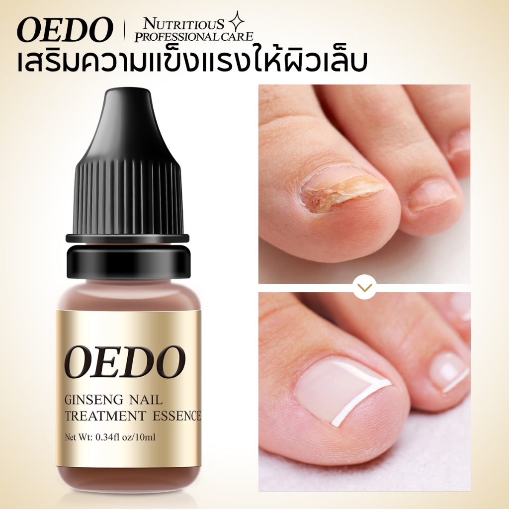 OEDO รักษาเชื้อราเล็บ ยาทาเชื้อราเล็บ เชื้อราที่เล็บ รักษาเล็บ เชื้อราที่เล็บ รักษาเล็บขบ ฆ่าเชื้อราที่เล็บ 10ml