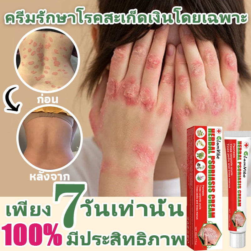 มีประสิทธิภาพ 100%🔥ครีมป้องกันเชื้อรา ครีมแก้คัน ครีมสะเก็ดเงิน บรรเทาอาการคัน ที่มีประสิทธิภาพกับการติดเชื้อที่เชื้อรา กลาก ผิว ครีม