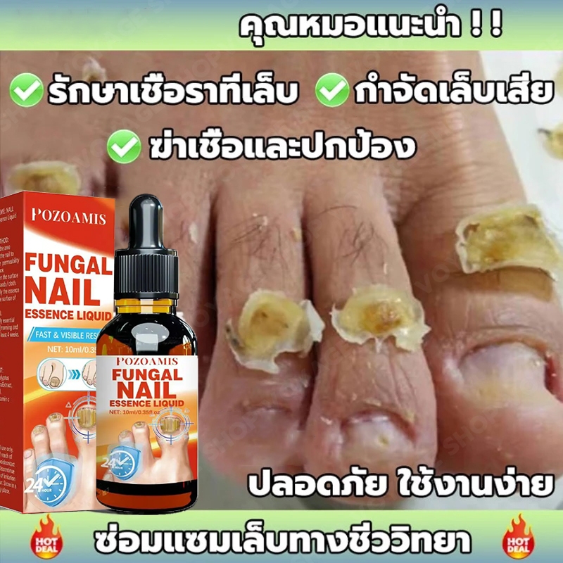 เซรั่มดูแลเล็บ นําเข้าจากญี่ปุ่น รักษาเชื้อราและซ่อมแซมเล็บขบ