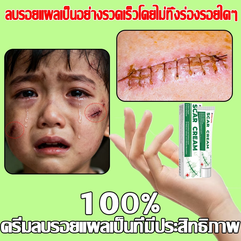 ครีมลบรอยแผลเป็นผ่าตัดครีมซ่อมแซมรอยแผลเป็นครีมซ่อมแซมรอยแผลเป็นเหมาะสําหรับผิวหน้าและผิวกาย